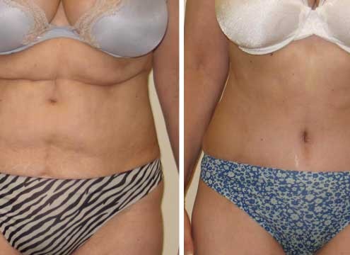 Tummy Tuck Before & After Photo