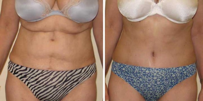 Tummy Tuck Before & After Photo