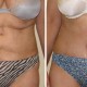 Tummy Tuck Before & After Photo