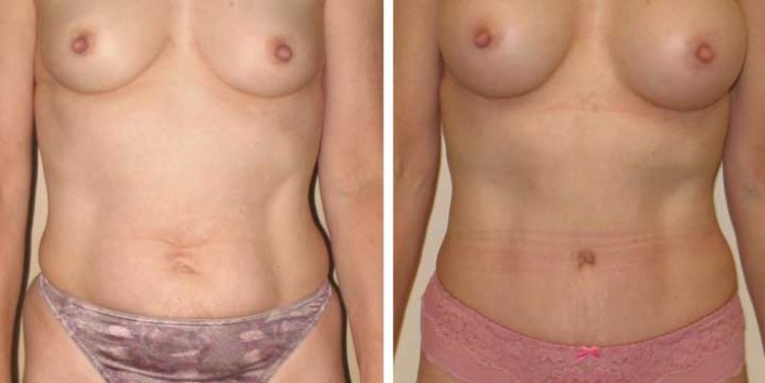 Tummy Tuck Before & After Photo