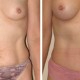 Tummy Tuck Before & After Photo