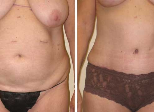 Tummy Tuck Before & After Photo