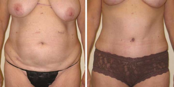 Tummy Tuck Before & After Photo