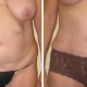 Tummy Tuck Before & After Photo