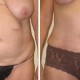 Tummy Tuck Before & After Photo