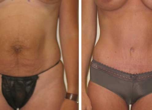 Tummy Tuck Before & After Photo