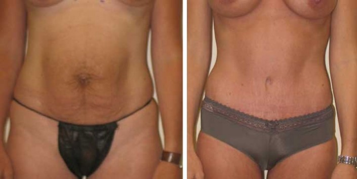 Tummy Tuck Before & After Photo