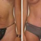 Tummy Tuck Before & After Photo