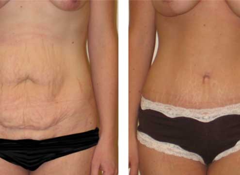 Tummy Tuck Before & After Photo