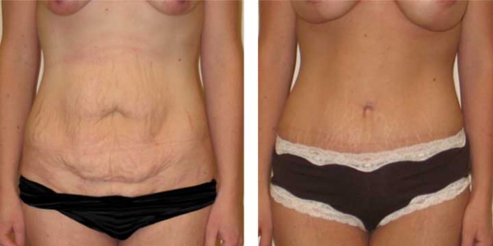 Tummy Tuck Before & After Photo