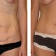 Tummy Tuck Before & After Photo