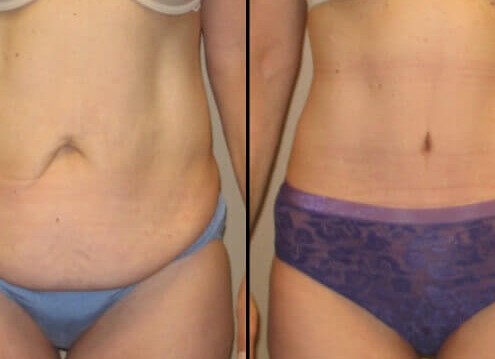 Tummy Tuck Case