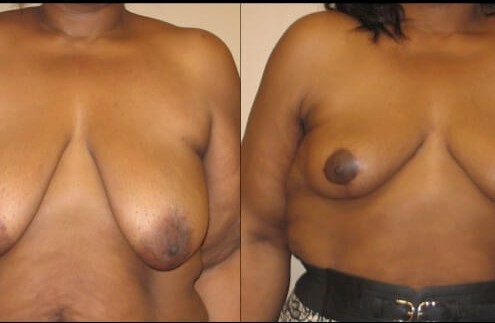 breast lift case 22 front