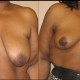 breast lift case 22 front