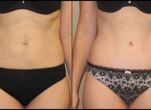 tummy tuck case 44 front