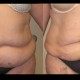 liposuction case 17 front