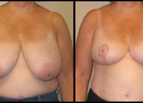 breast lift case 22 front