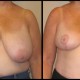 breast lift case 22 front