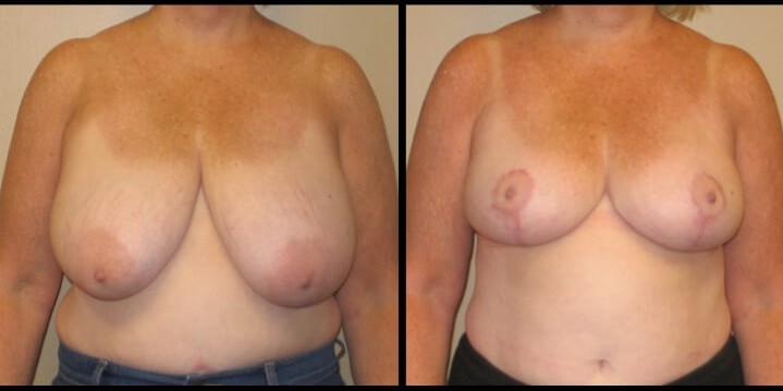 breast lift case 22 front