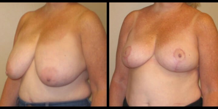 breast lift case 22 left oblique
