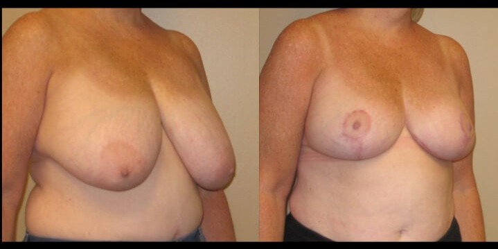 breast lift case 22 right oblique