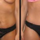 Tummy Tuck case 45 front