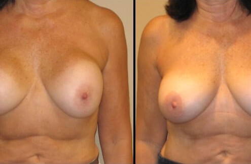 Breast revision augmentation case 6 front