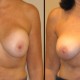 Breast revision augmentation case 6 front