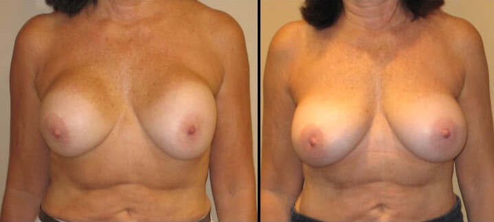 Breast revision augmentation case 6 front