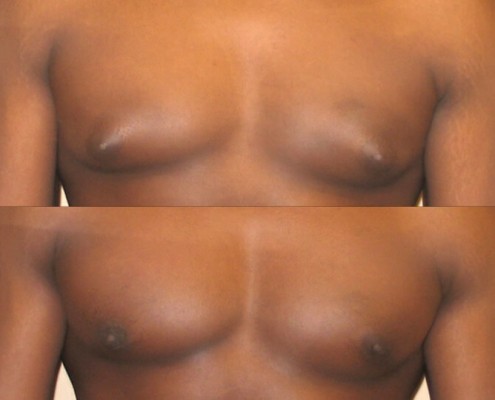 Gynecomastia case 6 front