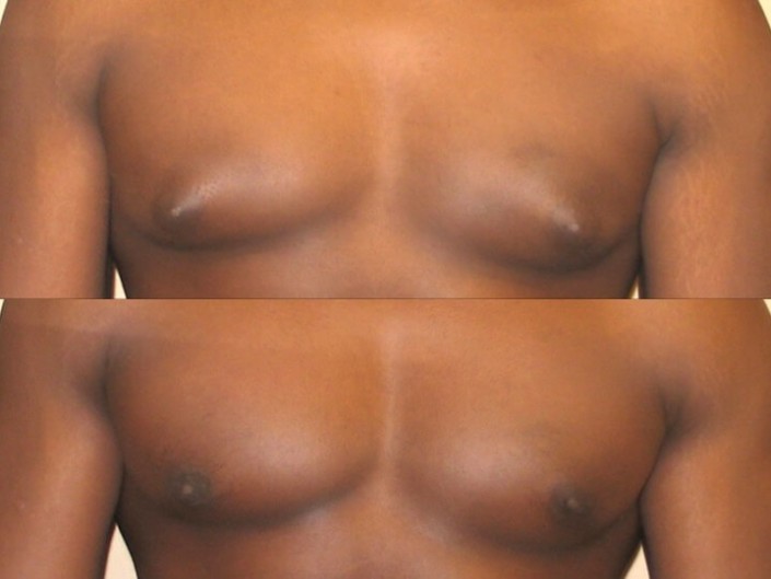 Gynecomastia case 6 front