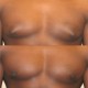 Gynecomastia case 6 front