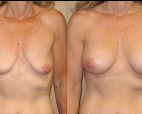 breast lift with implants case 13 front