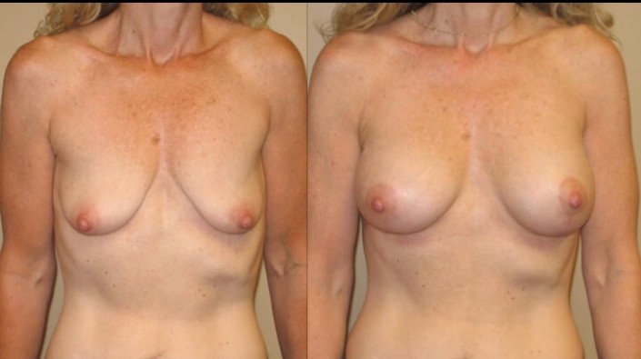 breast lift with implants case 13 front