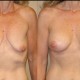 breast lift with implants case 13 front