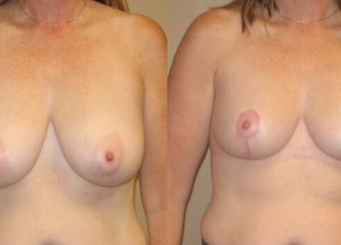 breast lift case 24 front
