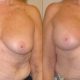 Breast augmentation case 30 front