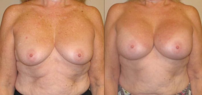 Breast augmentation case 30 front