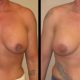 revision breast aug case 9 front