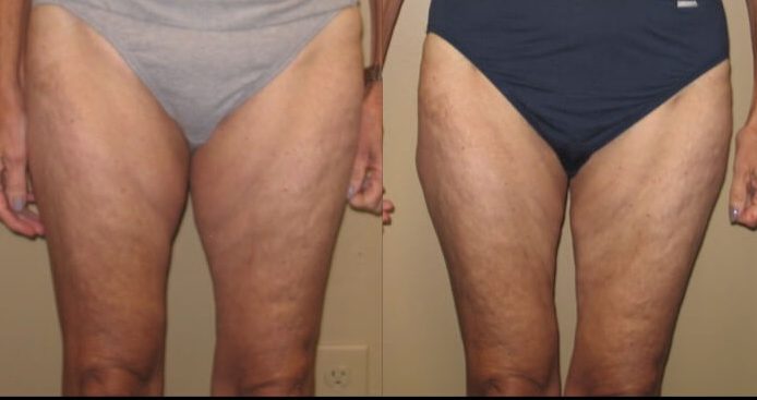 Case 28 liposuction front