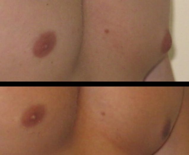 Gynecomastia Case 10 right oblique