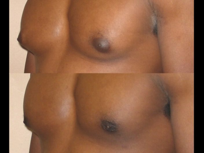 Gynecomastia Case 8 left oblique