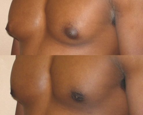 Gynecomastia Case 8 left oblique