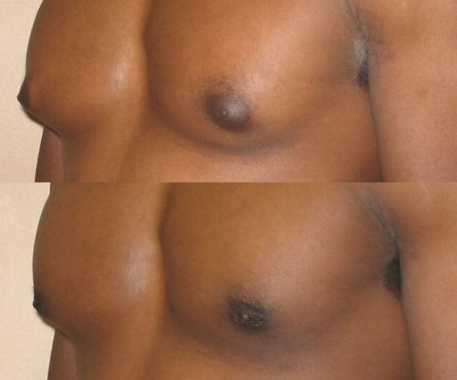 Gynecomastia Case 8 left oblique