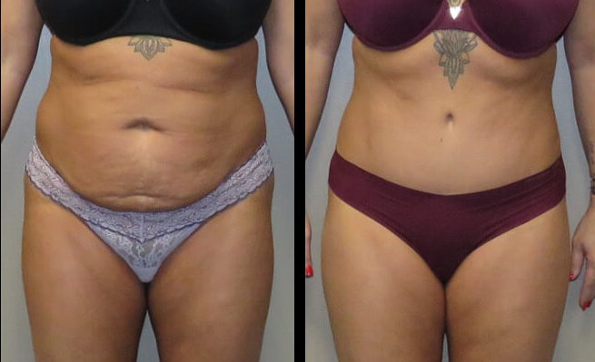 Tummy Tuck: Case 33 - Maier Plastic Surgery