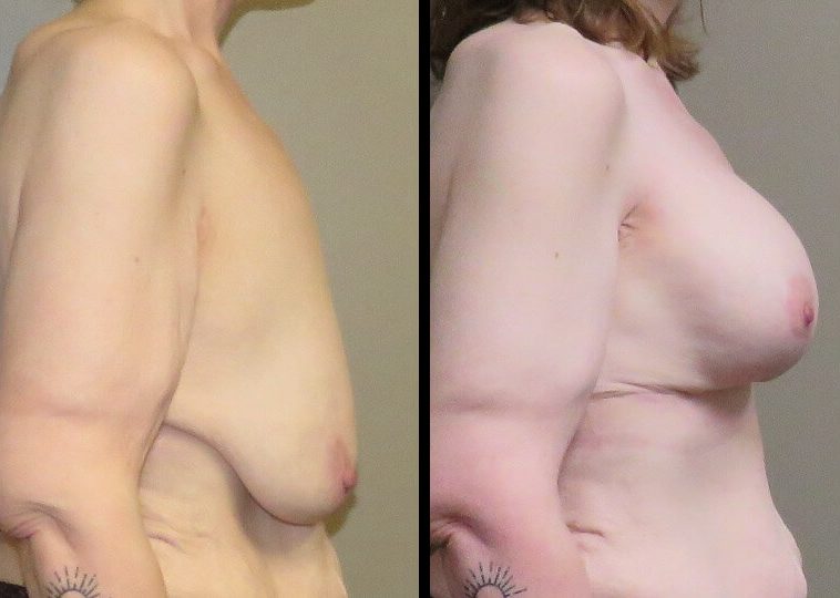 Case 15 Breast lift with implants right side